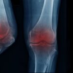 آرتریت زانو ؛ از پیر شدن تا تأثیر سبک زندگی