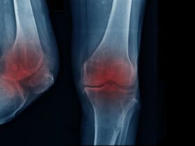 آرتریت زانو ؛ از پیر شدن تا تأثیر سبک زندگی