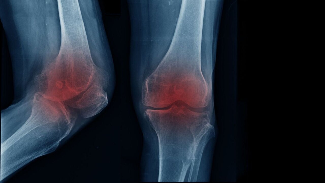 آرتریت زانو ؛ از پیر شدن تا تأثیر سبک زندگی