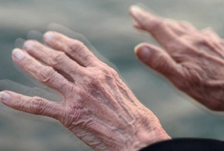 زندگی با پارکینسون ؛ وابسته به مصنوعی