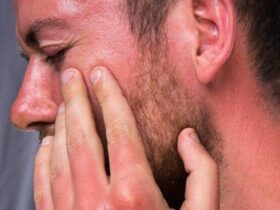 Sunburn Arbaeen ، یکی از مشکلات معمول پیاده روی