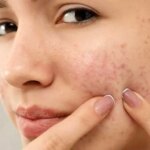 از یک آکنه ساده تا یک بیماری مزمن ؛ وقتی پوست سیگنال است