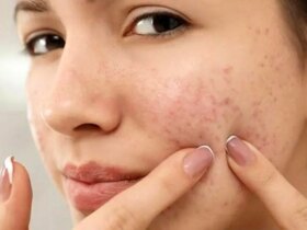 از یک آکنه ساده تا یک بیماری مزمن ؛ وقتی پوست سیگنال است