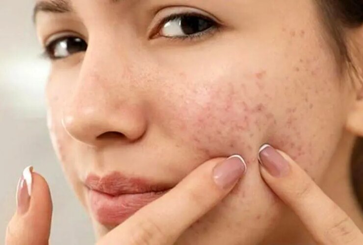 از یک آکنه ساده تا یک بیماری مزمن ؛ وقتی پوست سیگنال است