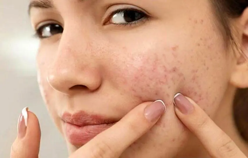 از یک آکنه ساده تا یک بیماری مزمن ؛ وقتی پوست سیگنال است