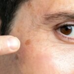 علائم اولیه سرطان پوست