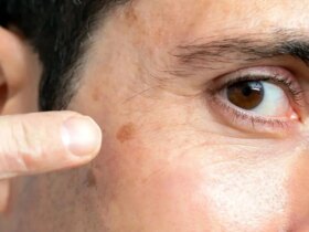 علائم اولیه سرطان پوست