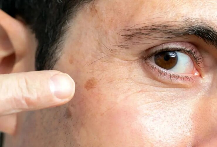 علائم اولیه سرطان پوست