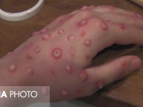 آیا ویروس آبله به زونا مرتبط است؟