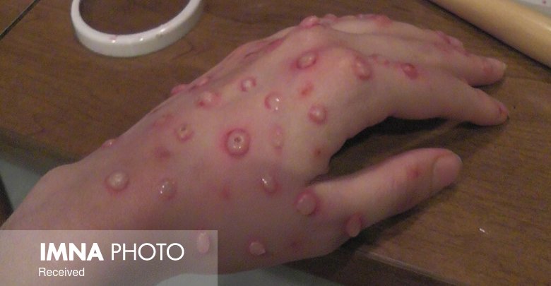 آیا ویروس آبله به زونا مرتبط است؟