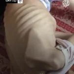 برای دیدن قحطی در غزه ، مریم ، 5 نفر دیگر ، پوست و استخوان مجرد