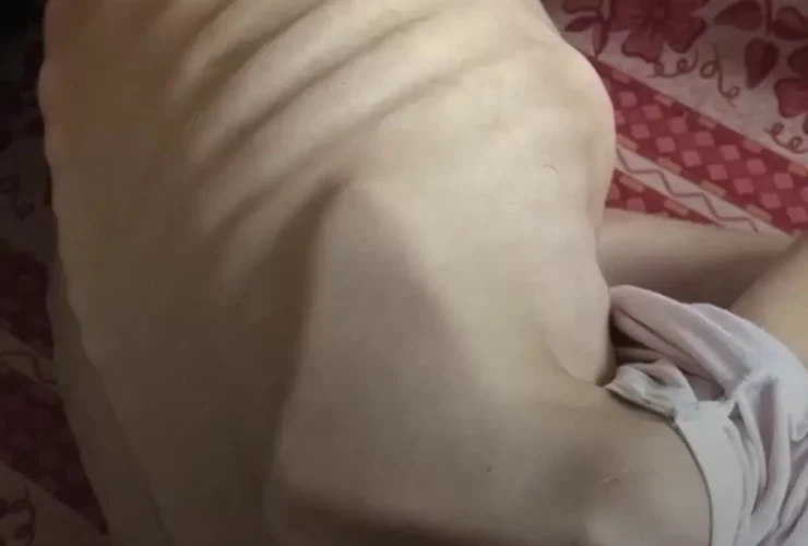 برای دیدن قحطی در غزه ، مریم ، 5 نفر دیگر ، پوست و استخوان مجرد