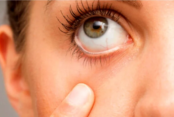 علائم بیماری کلیوی در چشم!