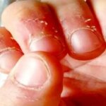 علت پوست در اطراف ناخن و روشهای درمانی است