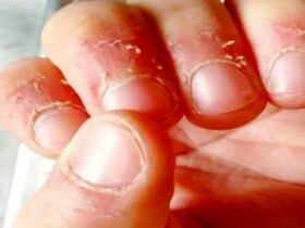 علت پوست در اطراف ناخن و روشهای درمانی است