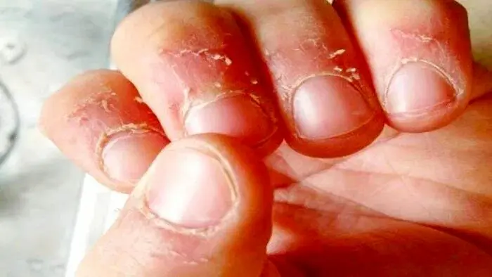 علت پوست در اطراف ناخن و روشهای درمانی است