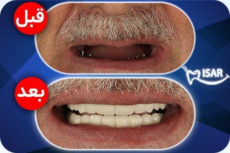 ایمپلنت و ارتودنسی و کامپوزیت دندانپزشکی