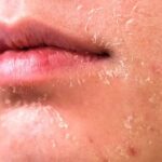 خشکی پوست در پاییز + دلیل ، علائم و راهکارهای پیشگیری