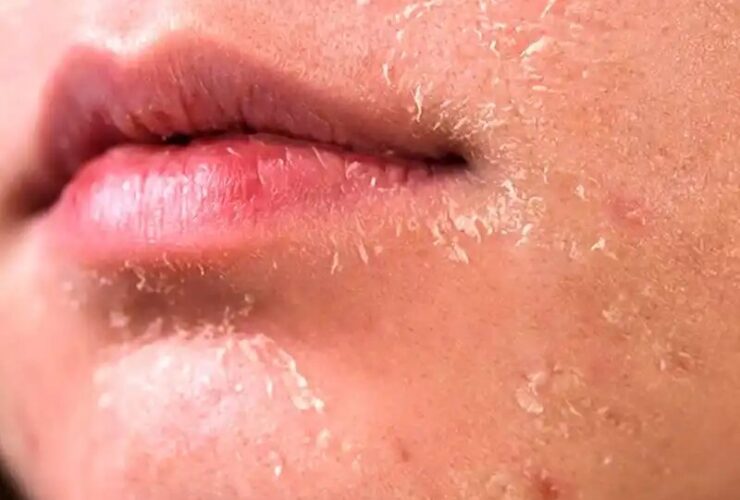 خشکی پوست در پاییز + دلیل ، علائم و راهکارهای پیشگیری
