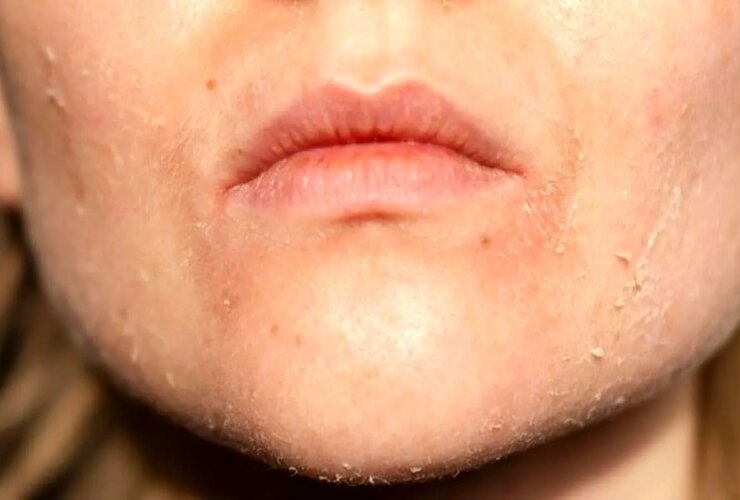 روشهای ساده برای کاهش پوست خشک در پاییز