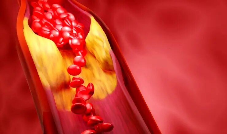 آیا باید از کلسترول و تری گلیسیرید ترس داشته باشید؟ 26 آیا باید از کلسترول و تری گلیسیرید ترس داشته باشید؟