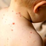 هشدار مینو محارف در مورد آمار فاجعه سرخک در ایران