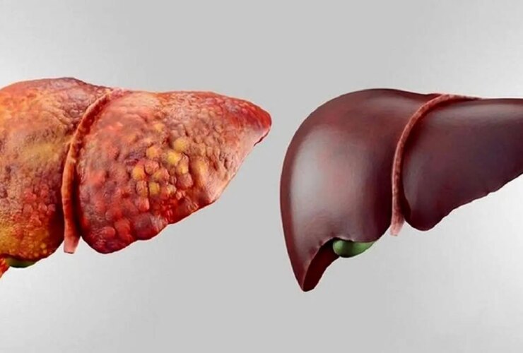 علائم پنهان روشهای کبد / کبد چرب 12 علائم پنهان روشهای کبد / کبد چرب