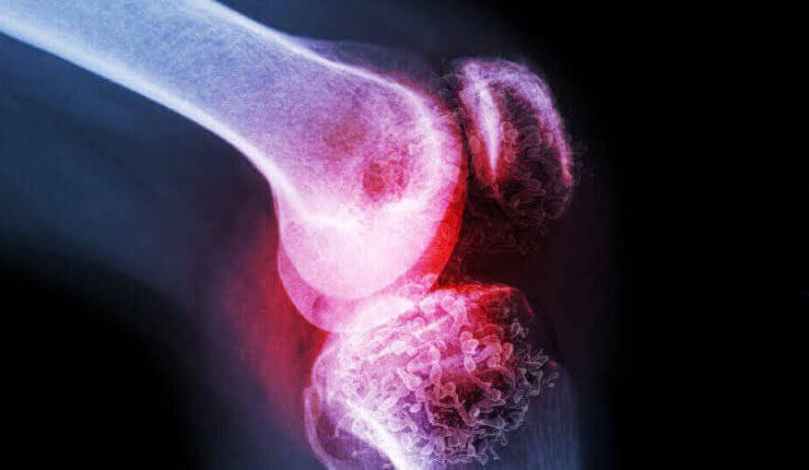 کاهش تراکم استخوان بعد از 30 سالگی / آیا پوکی استخوان باعث کاهش قد می شود؟ 15 کاهش تراکم استخوان بعد از 30 سالگی / آیا پوکی استخوان باعث کاهش قد می شود؟