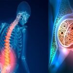 پوکی استخوان یک مشکل عمده بهداشت عمومی است