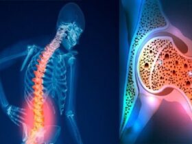 پوکی استخوان یک مشکل عمده بهداشت عمومی است