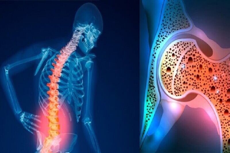 پوکی استخوان یک مشکل عمده بهداشت عمومی است