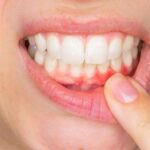 بایدها و نبایدها برای التهاب لثه نوجوانان
