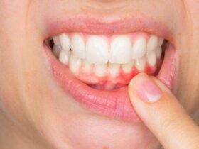 بایدها و نبایدها برای التهاب لثه نوجوانان