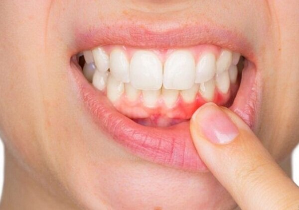 بایدها و نبایدها برای التهاب لثه نوجوانان