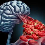 درمان سکته مغزی در بیمارستان های دولتی تحت بیمه درمانی رایگان است