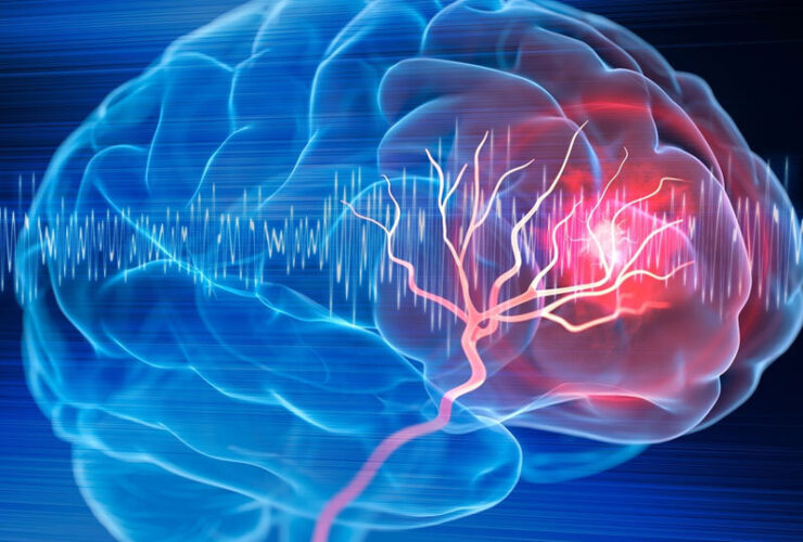 رسیدن سریع به بیمارستان کلید درمان موثر سکته است 30 رسیدن سریع به بیمارستان کلید درمان موثر سکته است