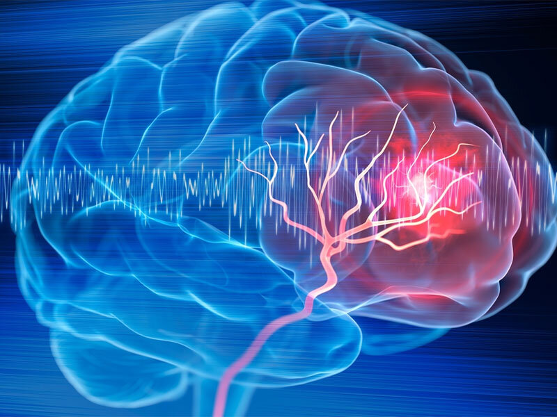 رسیدن سریع به بیمارستان کلید درمان موثر سکته است 1 رسیدن سریع به بیمارستان کلید درمان موثر سکته است