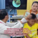 برای دیدن؛ خارج کردن سوسک زنده از گوش کودک