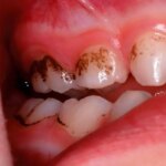 غذاهایی که برای سلامت دندان مفید هستند