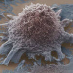 توجه به تراکم استخوان و جلوگیری از تخریب آن در بیماران سرطانی ضروری است.