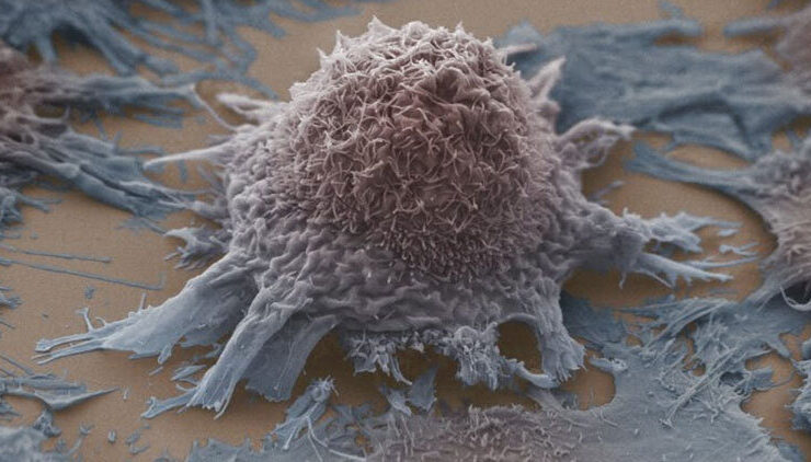 توجه به تراکم استخوان و جلوگیری از تخریب آن در بیماران سرطانی ضروری است. 27 توجه به تراکم استخوان و جلوگیری از تخریب آن در بیماران سرطانی ضروری است.