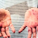 مدیرعامل خانه "ای بی": 95 درصد موارد پروانه ای ناشی از ازدواج های خانوادگی است