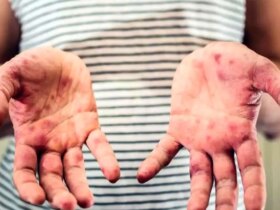 مدیرعامل خانه "ای بی": 95 درصد موارد پروانه ای ناشی از ازدواج های خانوادگی است 8 مدیرعامل خانه "ای بی": 95 درصد موارد پروانه ای ناشی از ازدواج های خانوادگی است