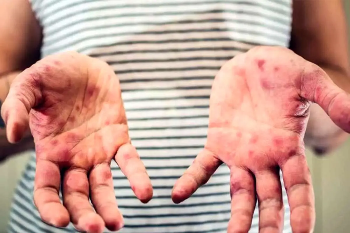 مدیرعامل خانه "ای بی": 95 درصد موارد پروانه ای ناشی از ازدواج های خانوادگی است 1 مدیرعامل خانه "ای بی": 95 درصد موارد پروانه ای ناشی از ازدواج های خانوادگی است