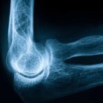 پوکی استخوان؛ زخمی پنهان در ستون های سالم بدن