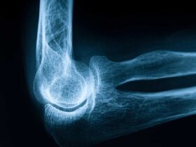 پوکی استخوان؛ زخمی پنهان در ستون های سالم بدن 8 پوکی استخوان؛ زخمی پنهان در ستون های سالم بدن