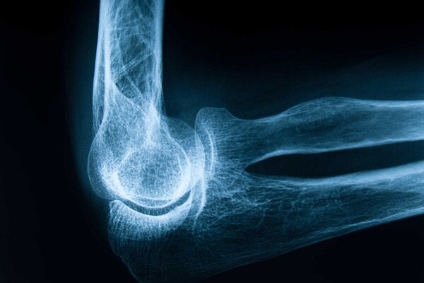 پوکی استخوان؛ زخمی پنهان در ستون های سالم بدن