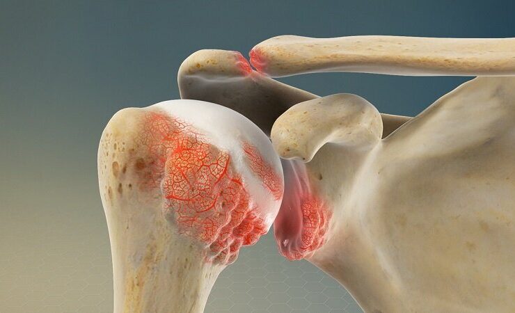 آرتریت زانو؛ بیماری مفاصل خاموش 11 آرتریت زانو؛ بیماری مفاصل خاموش