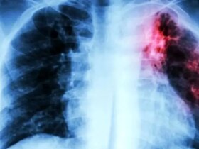 1.23 میلیون قربانی مرگبارترین بیماری عفونی جهان در سال 2024 9 صورت