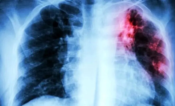 1.23 میلیون قربانی مرگبارترین بیماری عفونی جهان در سال 2024 6 صورت